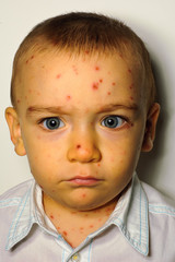 Child with pockmarks