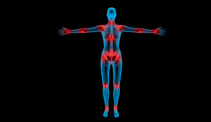 painful joints x-ray body human - obrazy, fototapety, plakaty
