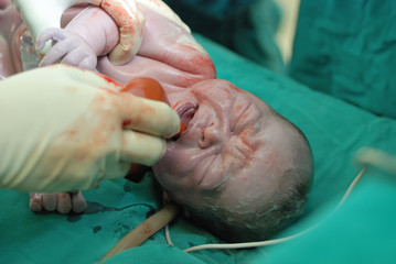 new born infant in the operation room - obrazy, fototapety, plakaty