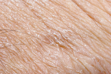 dry skin texture
