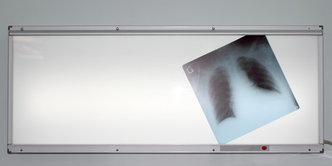 X-ray of the lungs on negatoscope