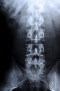 radiograph of human backbone