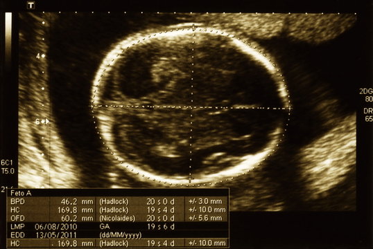 Imagen de ecograf&iacute;a ginecol&oacute;gica - Toma 3