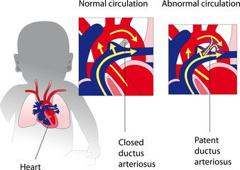 Patent ductus arteriosus