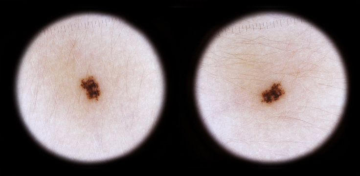 Clich&eacute;s m&eacute;dicaux d'un naevus