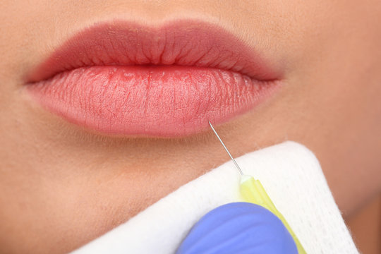 Cosmetic injection in woman's lips