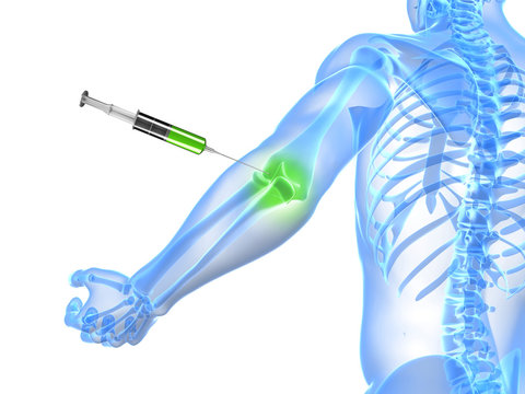 3d rendered illustration showing an elbow joint injection