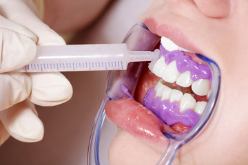 Zahnbehandlung Reinigung mit Gel auftragen Nahaufnahme