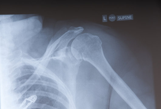x-ray of a persons shoulder