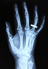 Radiography / Hand