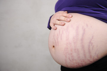 Pregnant woman with natural stomach - cracks on skin