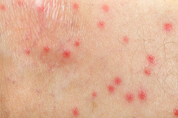 mosquito allergy on human skin