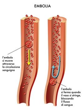 Embolia