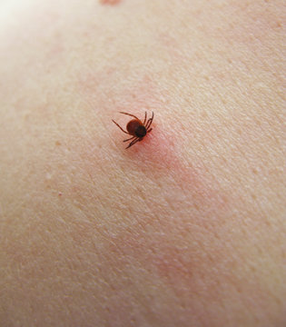 Tick sucking on skin