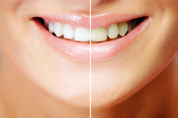 Teeth whitening , before and after comparison