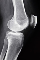 lateral radiograph right knee