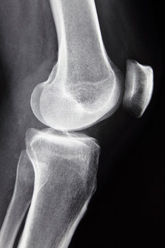 lateral radiograph right knee