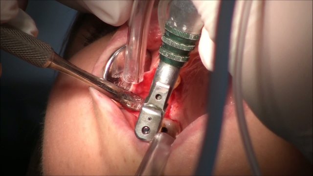 Oral Implantology surgery with fixture in dental surgery