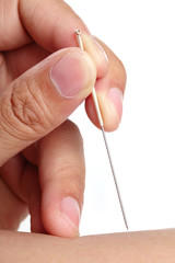 Acupuncture