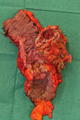 tumore intestinale
