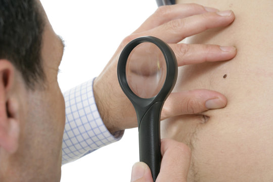 Dermatologue : examen d'un grain de beaut&eacute;