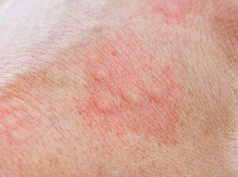 Allergische Reaktion