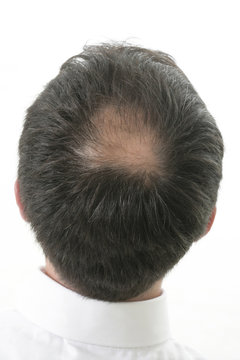 Tonsure-perte de cheveux