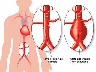 Aneurisma aorta addominale - obrazy, fototapety, plakaty