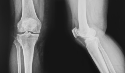 collection of x-ray normal knee