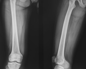 collection of x-ray normal knee