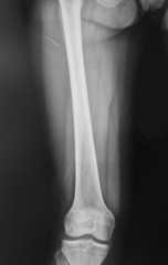 collection of x-ray normal knee