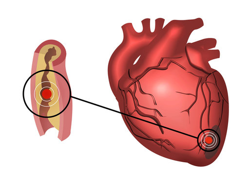Infarto