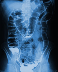 torso xray