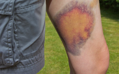 Severe bruising on a child's leg