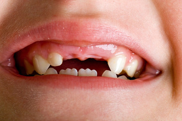 Child mouth missing teeth