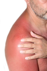Sonnenbrand
