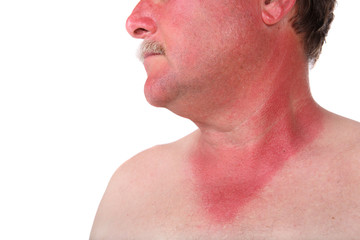 Man with a sunburn
