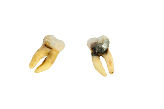 extracted molar with cavity on a white background