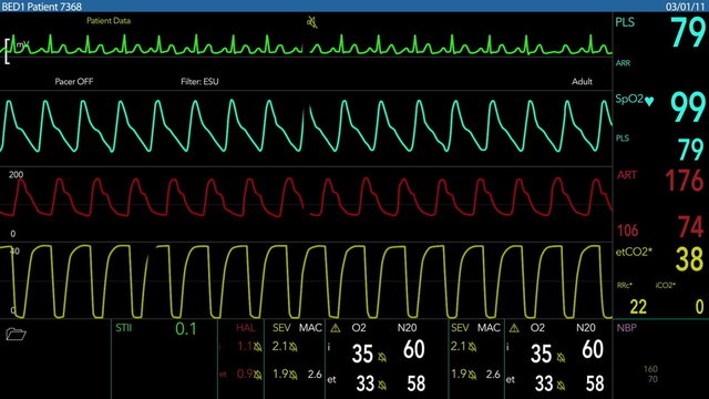EKG Screen Loopable