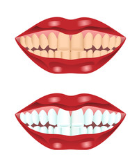 Fototapeta premium Teeth before and after whitening