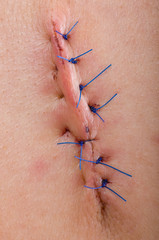 Suture macro.