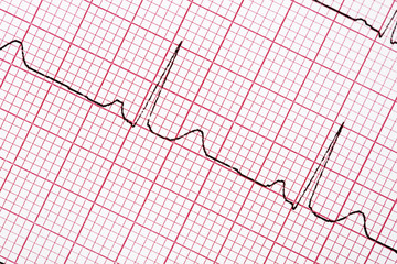 Digitally recorded ECG graph - electrocardiogram