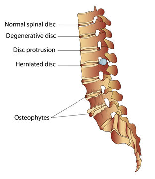 Spinal diseases