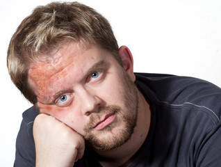 Verbrennung im Gesicht eines Mannes