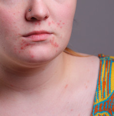 Image of acne on face