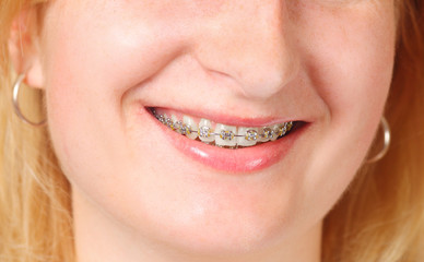Detail of young womans smile showing white teeth with braces