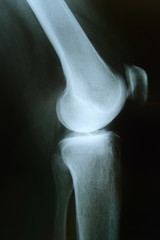 Knie mit Arthrose, Seitenansicht
