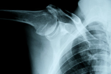 Röntgenbild Schultergelenk