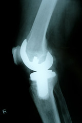 Seitenansicht Knieprothese