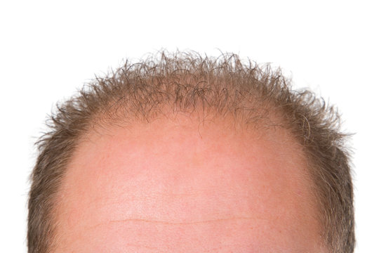 Schuetteres Haar